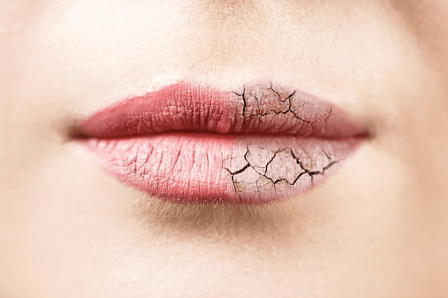 Чому сохнуть і печуть губи: причини та вирішення проблеми у 2025 році